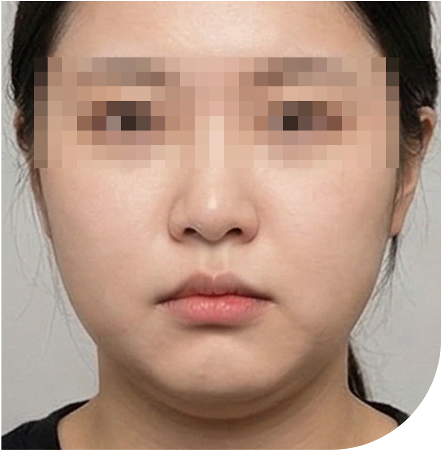 온다 리프팅 · 온다리프팅 · 인천 25 후 사진