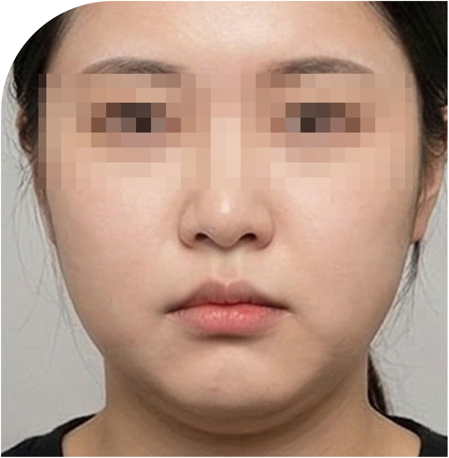 온다 리프팅 · 온다리프팅 · 인천 25 전 사진