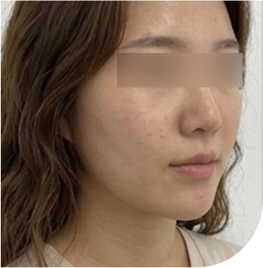 울쎄라피 프라임 · 인천 23 후 사진