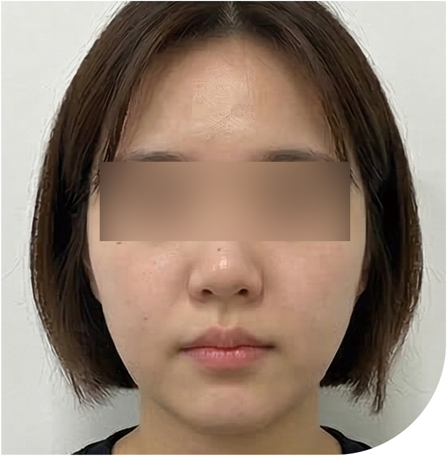 V핏 주사 · 인천 63 후 사진