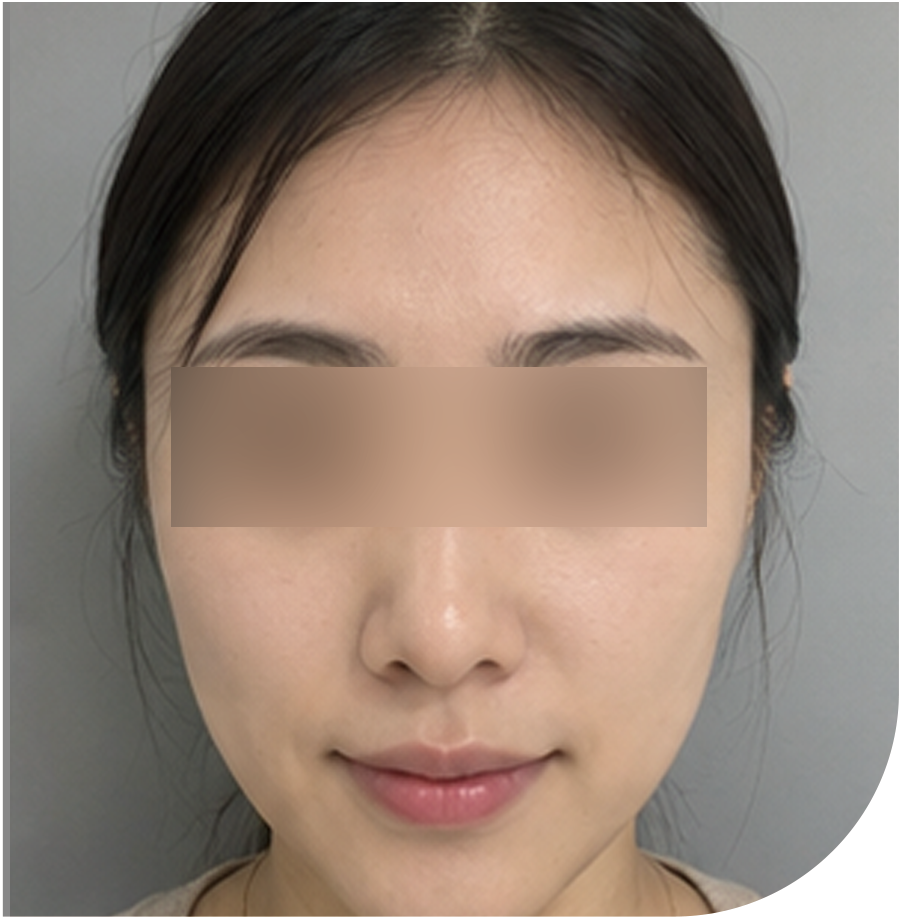 볼뉴머 리프팅 · 인천 79 후 사진