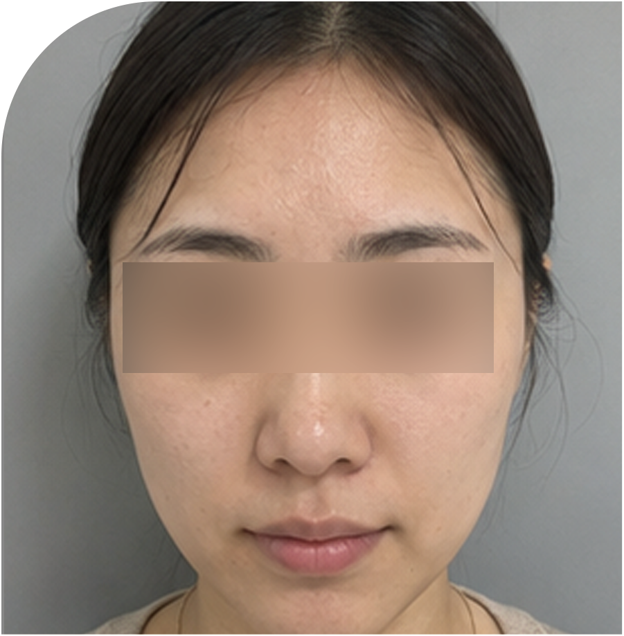 볼뉴머 리프팅 · 인천 79 전 사진